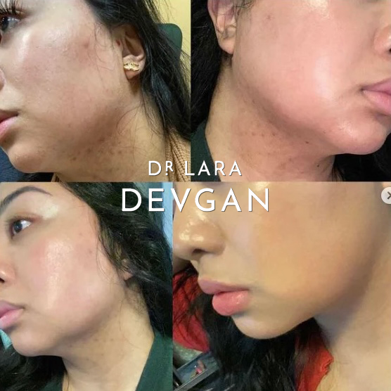 Dr. Devgan Advanced Lauric Acid Cleanser