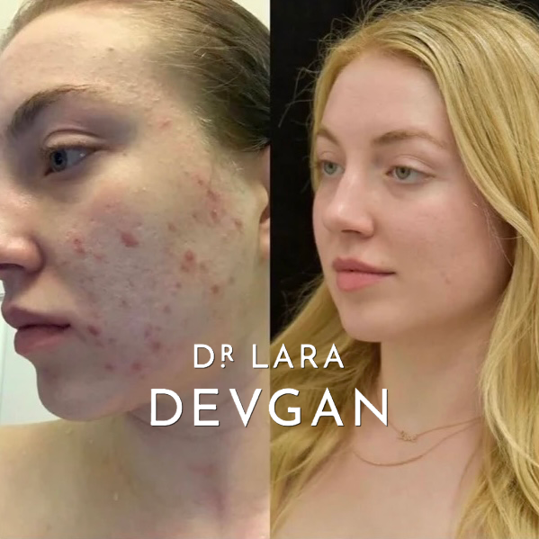 Dr. Devgan Advanced Lauric Acid Cleanser